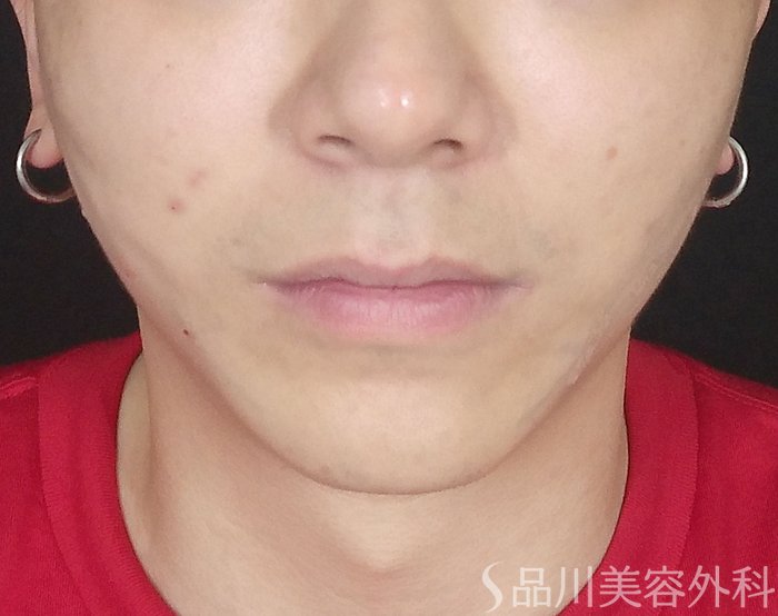 症例NO.65061のAFTER写真
