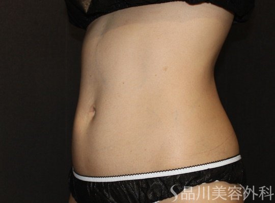 症例NO.74133のBEFORE写真