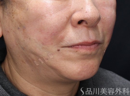 症例NO.72898のAFTER写真