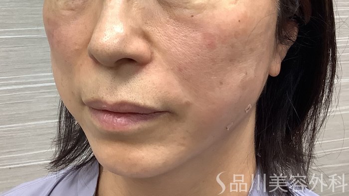 症例NO.62222のAFTER写真
