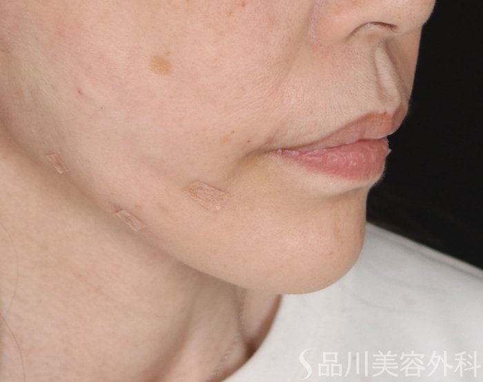 症例NO.73449のAFTER写真