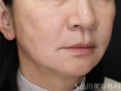 症例NO.69745のAFTER写真