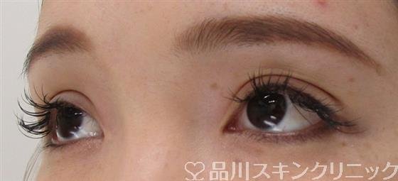 症例NO.42340のAFTER写真