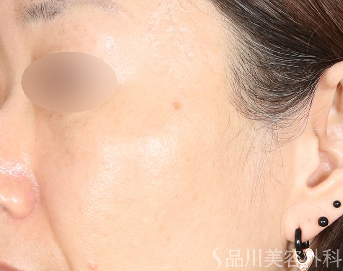 症例NO.72484のAFTER写真