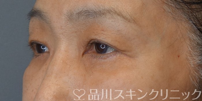 症例NO.74677のBEFORE写真