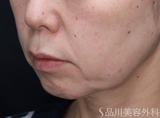 症例NO.73098のBEFORE写真