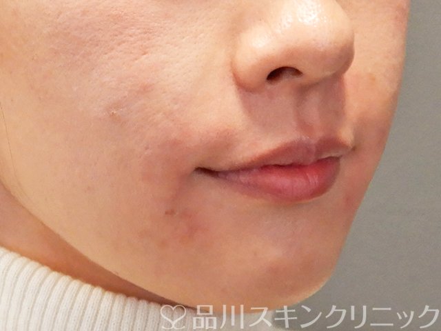 症例NO.69626のAFTER写真