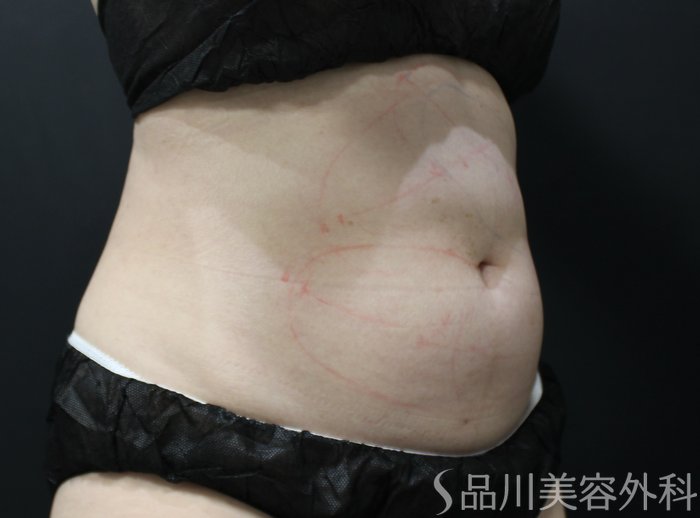 症例NO.75256のBEFORE写真