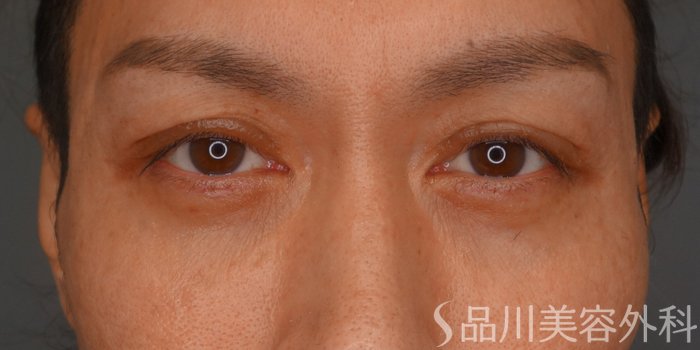 症例NO.74412のAFTER写真