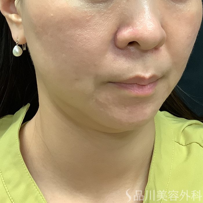 症例NO.75329のAFTER写真