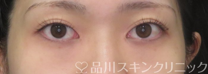 症例NO.74939のBEFORE写真