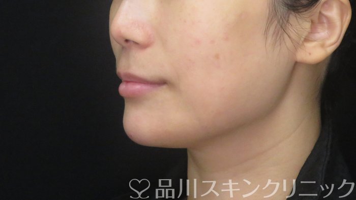 症例NO.72354のAFTER写真