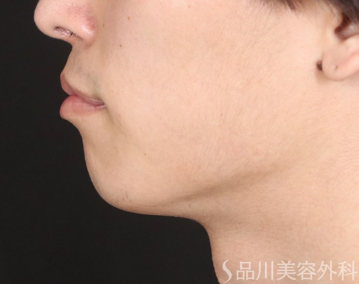 症例NO.73766のBEFORE写真