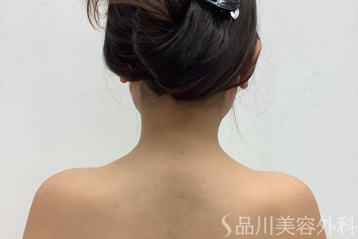 症例NO.62062のAFTER写真