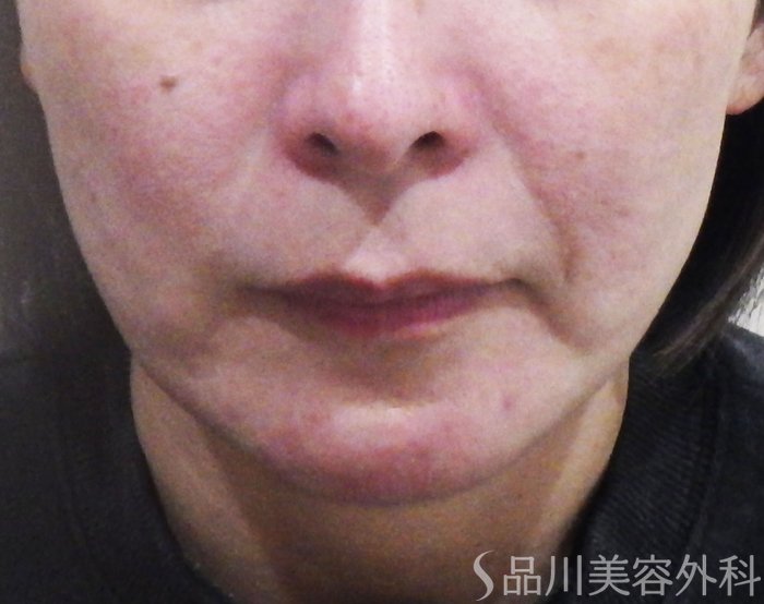 症例NO.73468のBEFORE写真