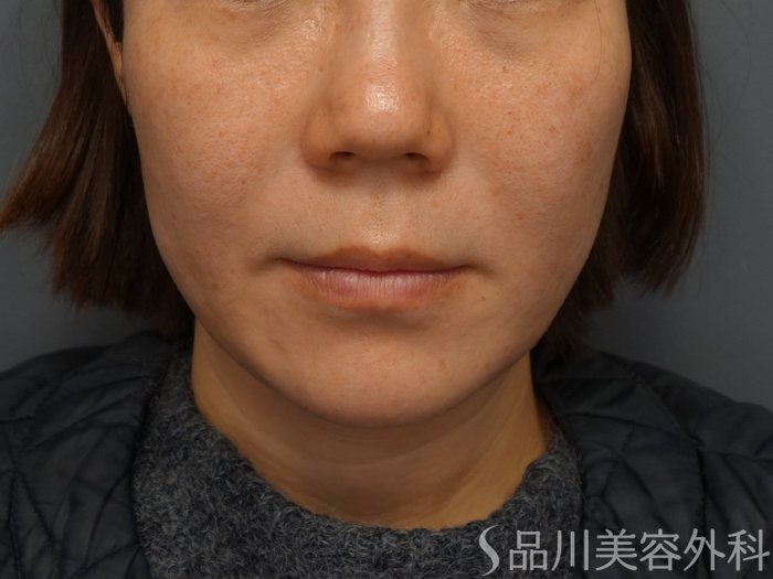 症例NO.74281のBEFORE写真