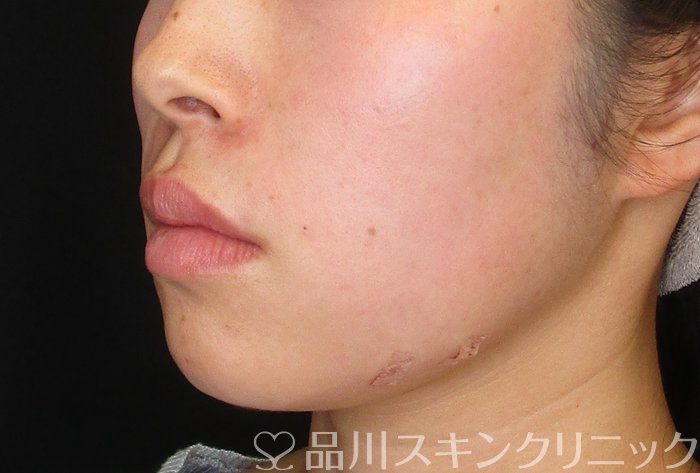 症例NO.74142のAFTER写真
