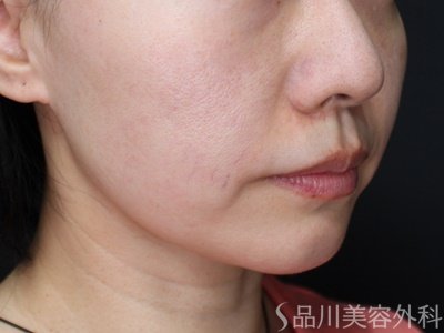 症例NO.71937のBEFORE写真