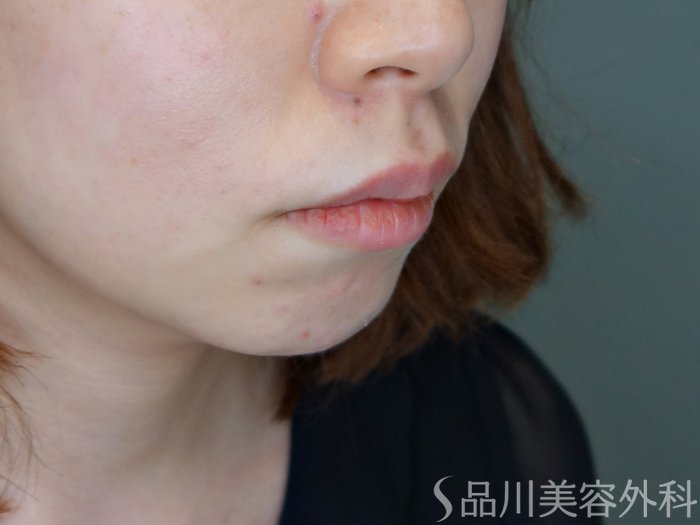 症例NO.70927のBEFORE写真