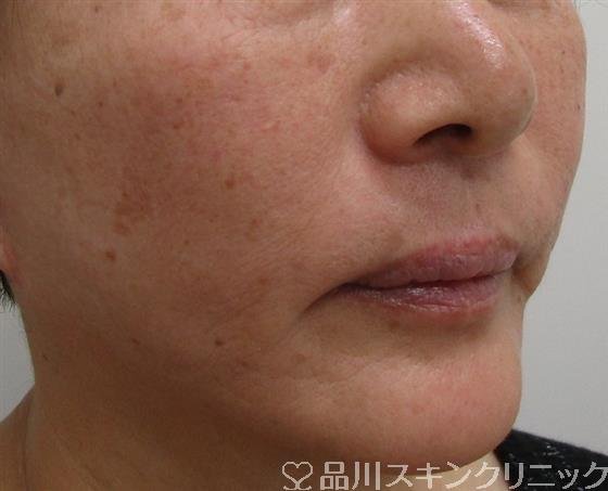 症例NO.41090のAFTER写真