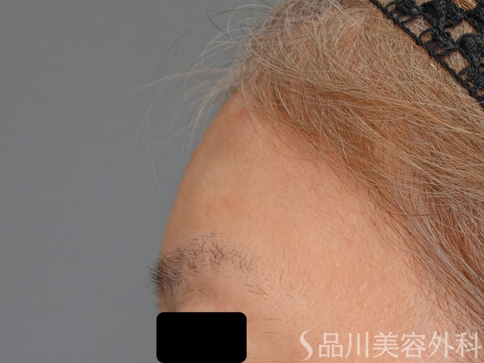 症例NO.70706のAFTER写真