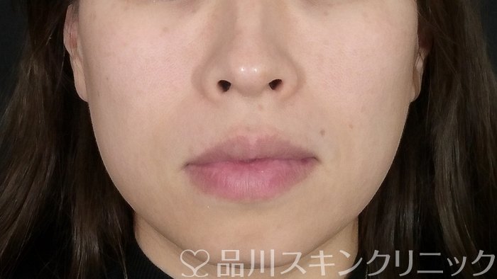 症例NO.72062のBEFORE写真