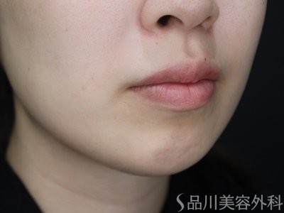 症例NO.73070のBEFORE写真