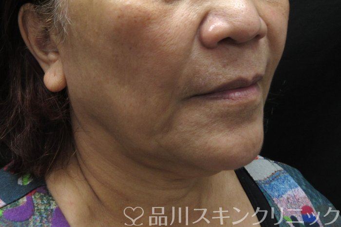症例NO.74642のBEFORE写真