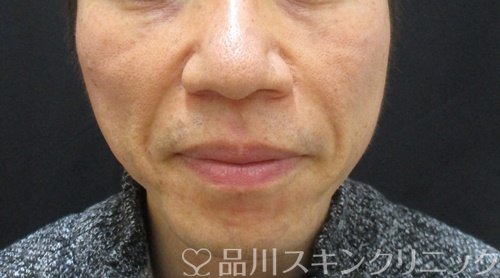 症例NO.69680のBEFORE写真