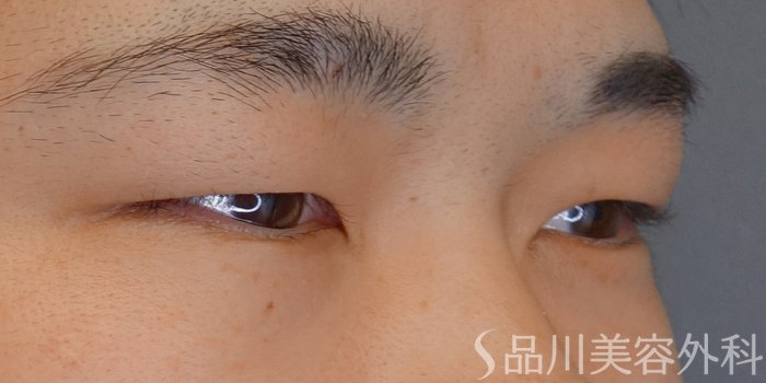 症例NO.70328のBEFORE写真