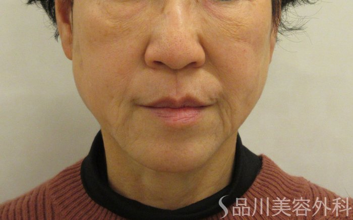 症例NO.69787のBEFORE写真