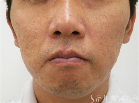 症例NO.30673のBEFORE写真