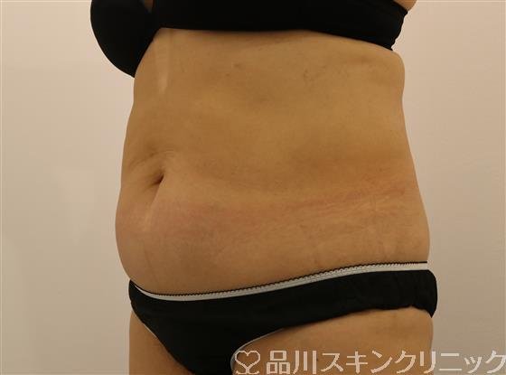 症例NO.43910のAFTER写真