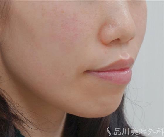 症例NO.32893のBEFORE写真