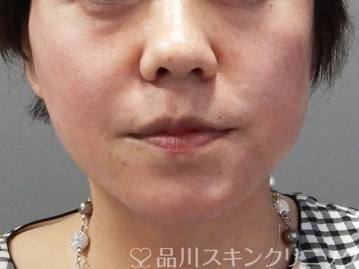 症例NO.71855のAFTER写真
