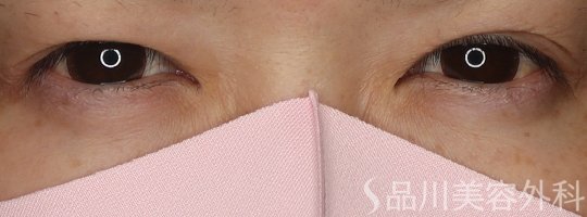 症例NO.62364のBEFORE写真