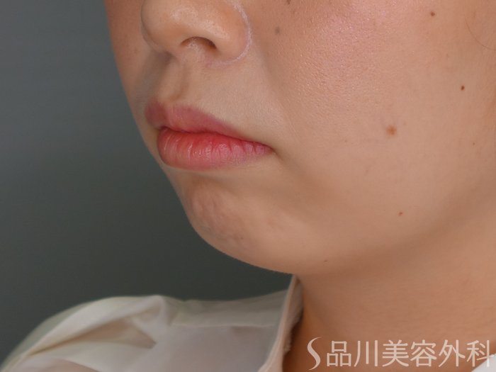 症例NO.69844のBEFORE写真