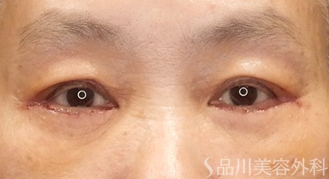症例NO.73848のAFTER写真