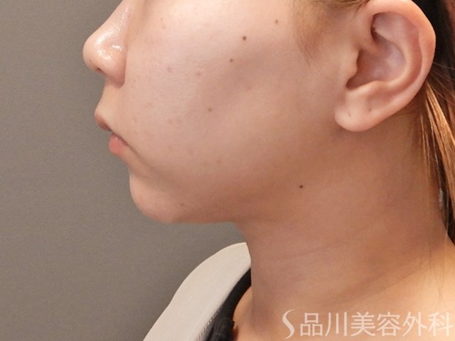 症例NO.74288のAFTER写真