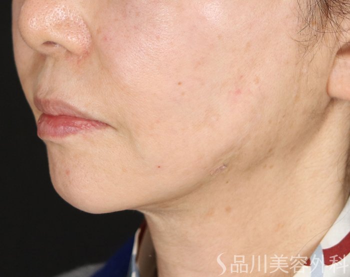 症例NO.72741のAFTER写真