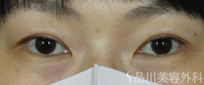 症例NO.70594のAFTER写真