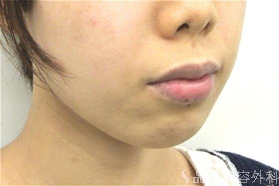 症例NO.18000のBEFORE写真