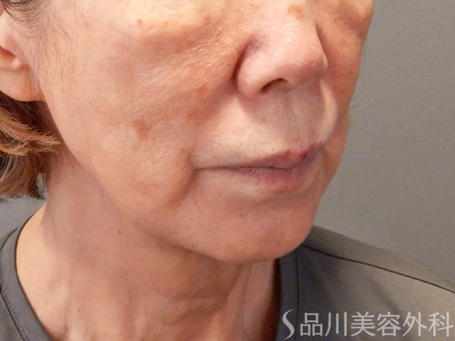 症例NO.73193のAFTER写真