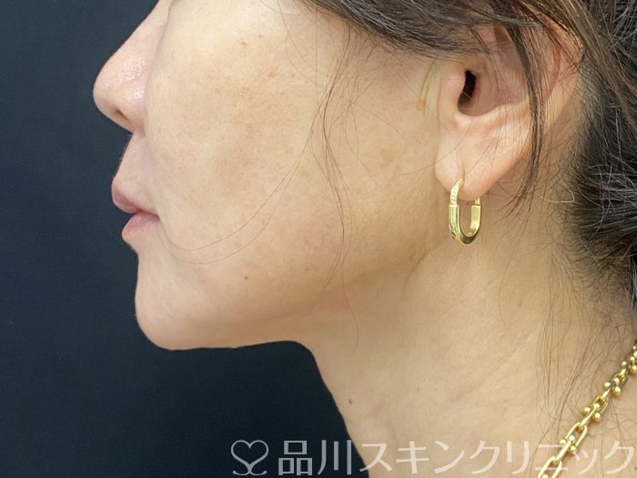 症例NO.74403のAFTER写真