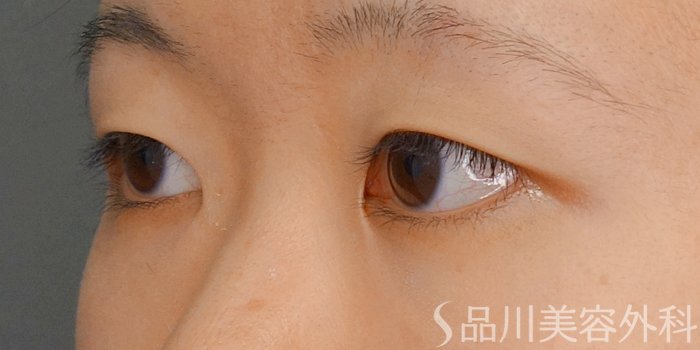 症例NO.71658のBEFORE写真