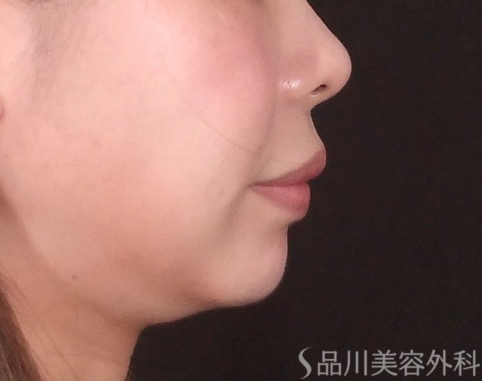 症例NO.70134のBEFORE写真