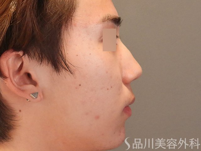 症例NO.74879のAFTER写真