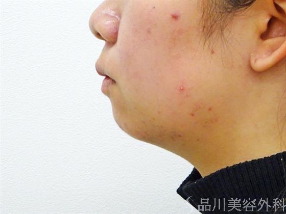 症例NO.50069のBEFORE写真
