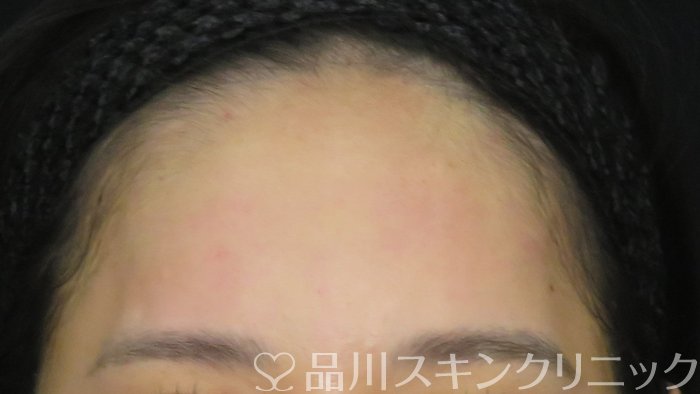症例NO.70862のAFTER写真