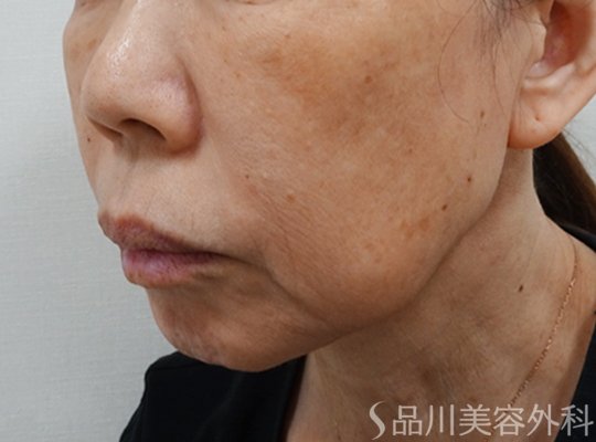 症例NO.71757のBEFORE写真